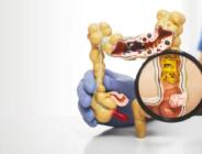 Bağırsak sağlığını tehdit eden 5 besin grubu