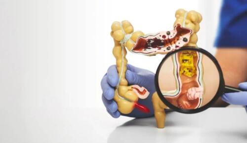 Bağırsak sağlığını tehdit eden 5 besin grubu